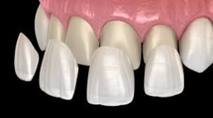 dental porcelain veneer tysons corner