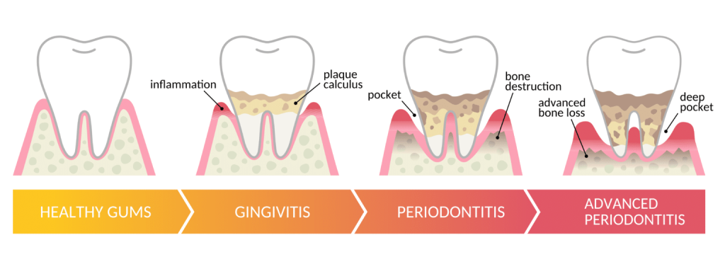 gum disease periodontal disease