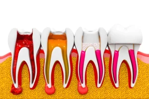 root canal treatment in tysons corner