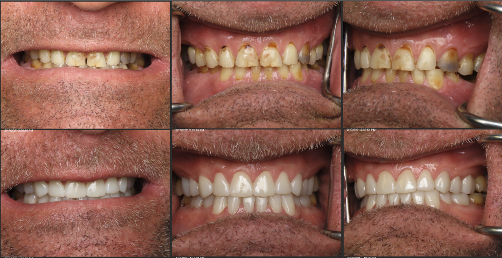 full mouth rehabilitation tysons corner