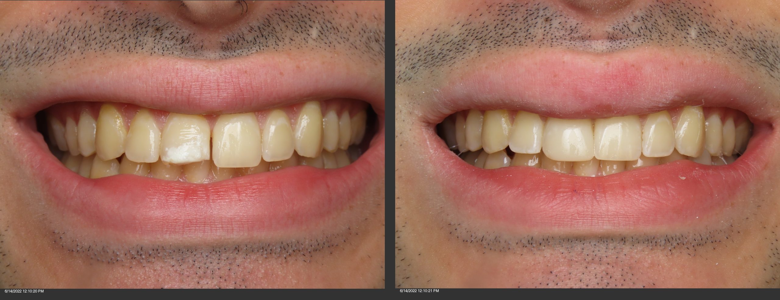 dental bonding front teeth tysons corner