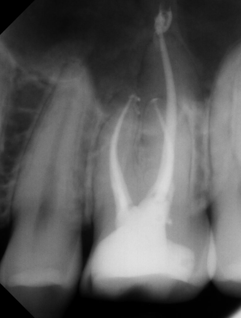 root canal Tysons Corner
