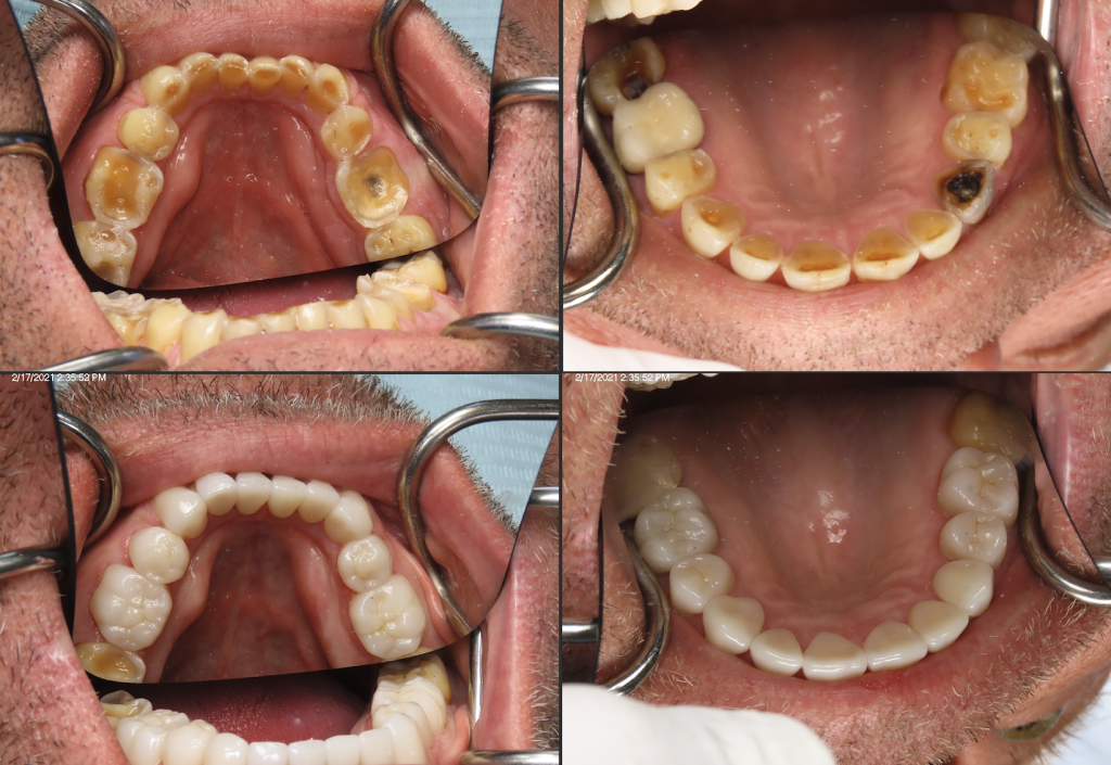 full mouth restoration tysons corner