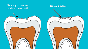 dental sealant Tysons Corner