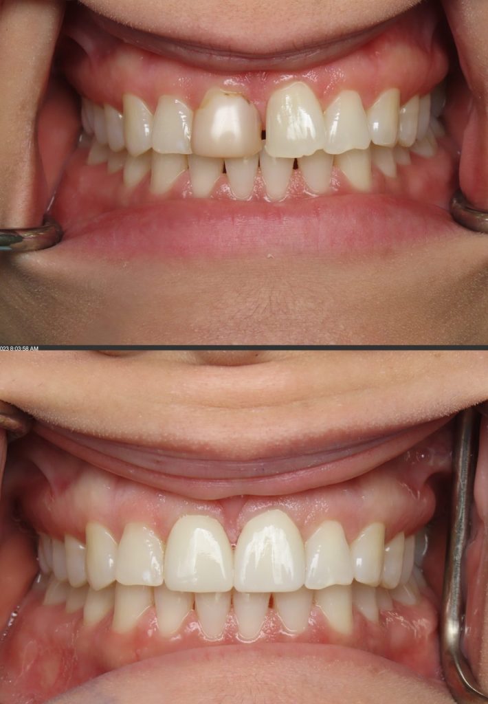 cosmetic front crown tysons