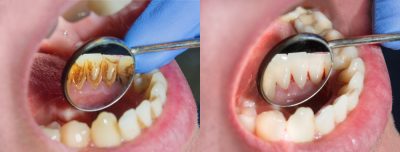 teeth cleaning tysons corner