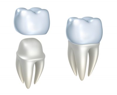 dental crowns tysons corner
