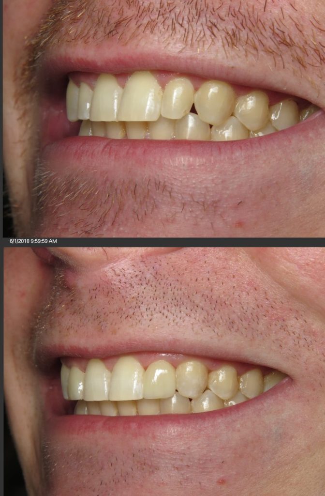 no prep veneers tysons corner