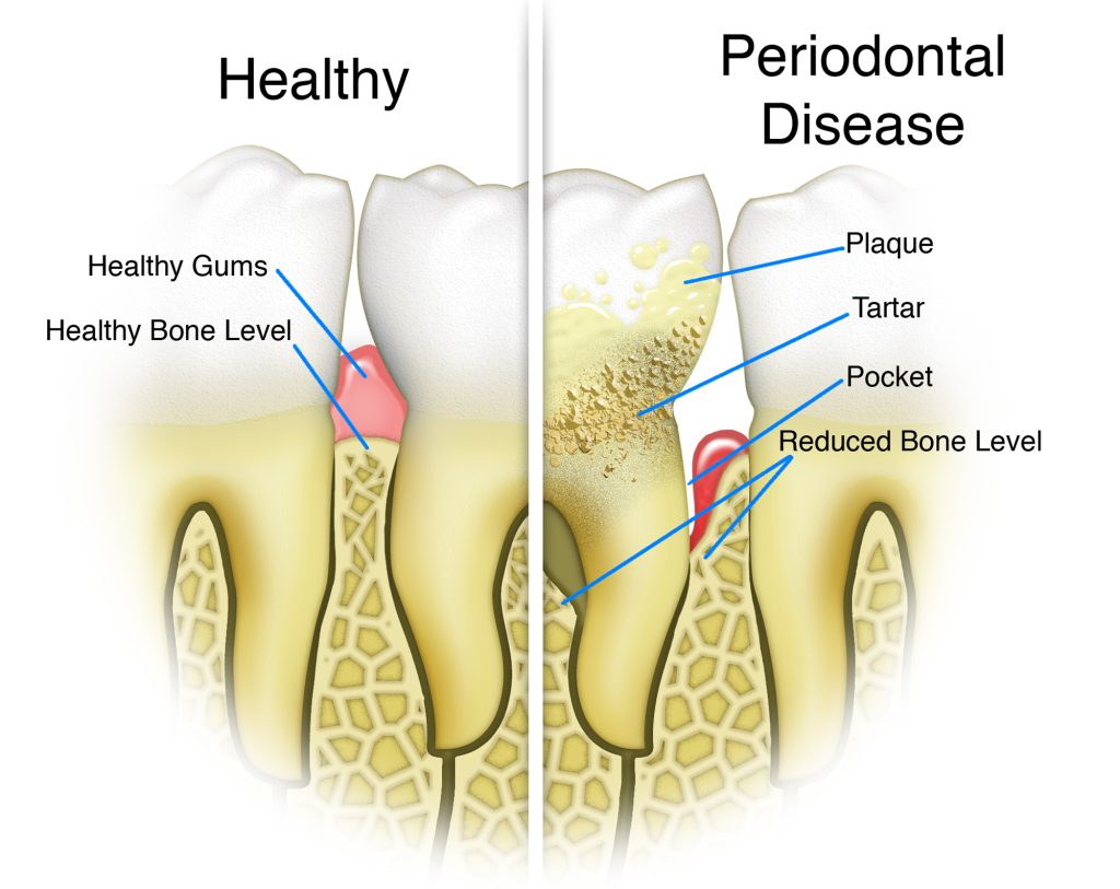 periodontal disease Tysons Corner