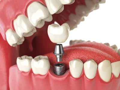 dental implant parts tysons corner
