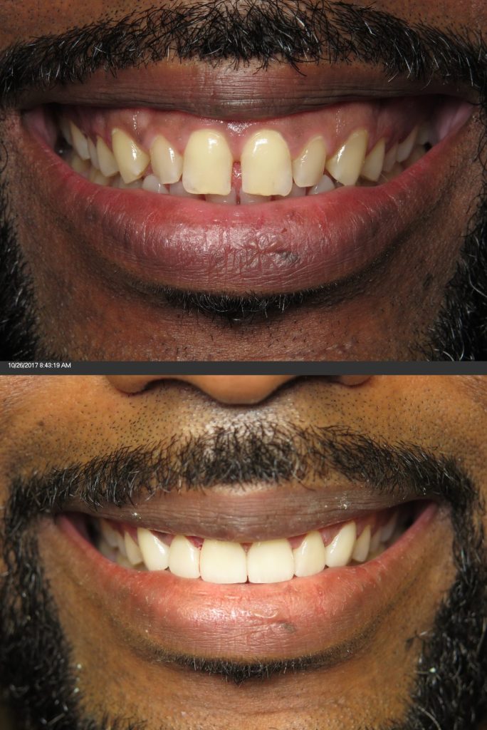 dentist veneers tysons corner