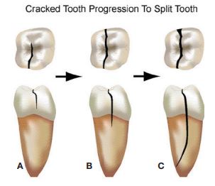 broken cracked tooth Tysons Corner