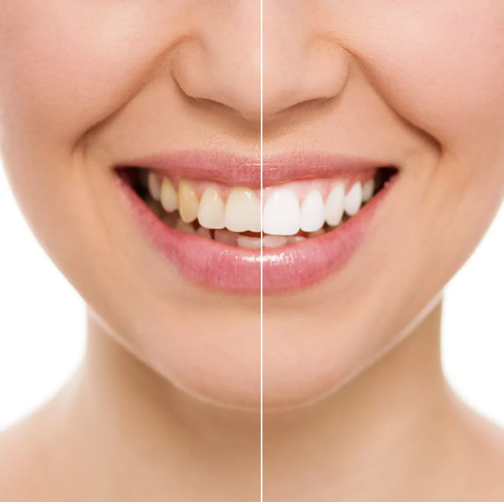 Before and after comparison showing professional teeth whitening results with a brighter, whiter smile and reduced tooth staining.