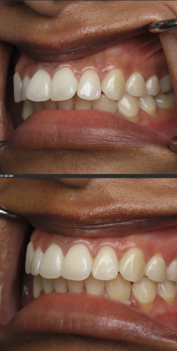 invisalign provider tysons corner