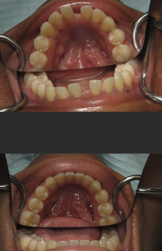 invisalign spacing tysons corner