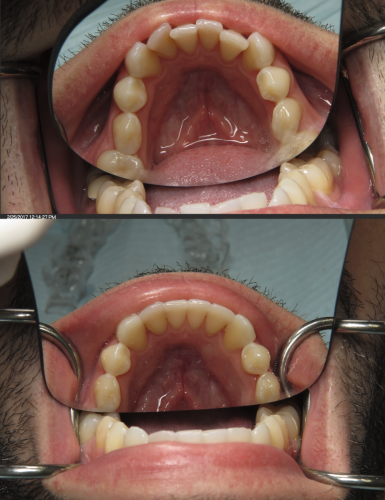 invisalign crowding tysons corner