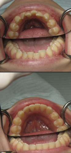 invisalign crowded teeth tysons corner